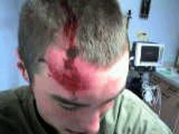 Head Injury