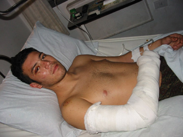 Broken Bones in Hospital